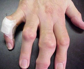 gishtat me deformime të kyçeve shkaktojnë dhimbje