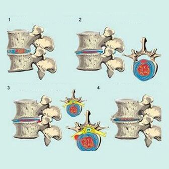 fazat e zhvillimit të osteokondrozës së qafës së mitrës