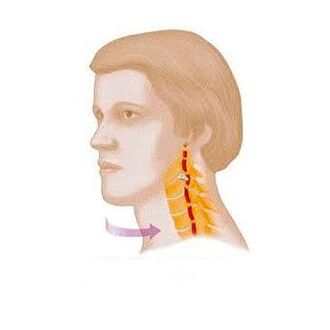sindromi vertebral me osteokondrozë cervikale