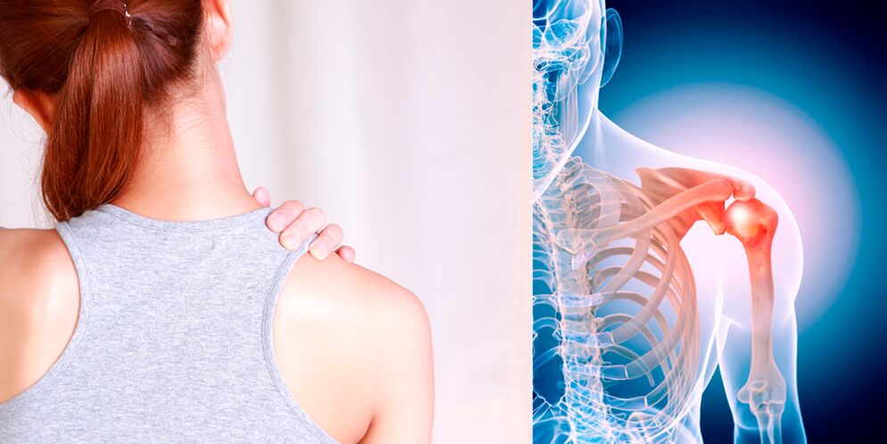 Zhvillimi i osteoartritit të shpatullës gradualisht çon në dhimbje të vazhdueshme