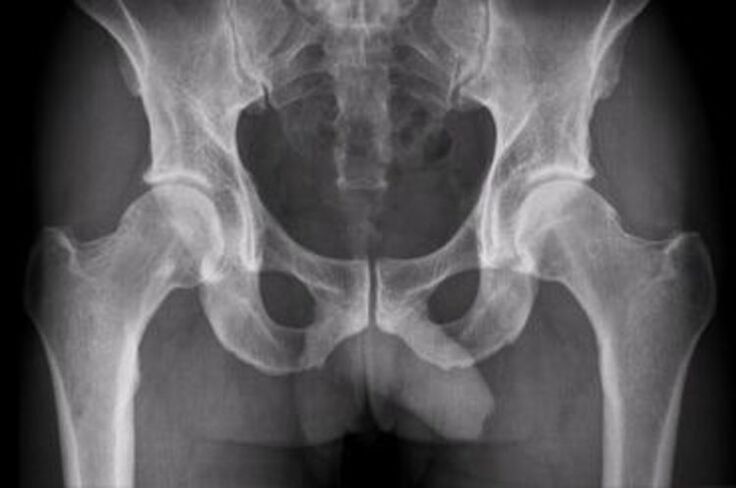 X-ray e kyçit të hip për dhimbje
