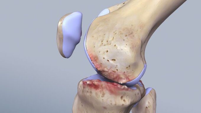 Struktura e nyjës së gjurit e prekur nga patologjia