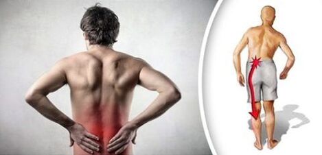 Sindromi i dhimbjes me osteokondrozë lumbare rrezaton në këmbë