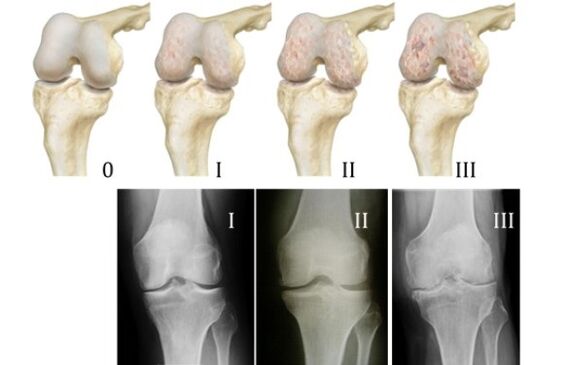 Metodat për diagnostikimin e artrozës së gjurit