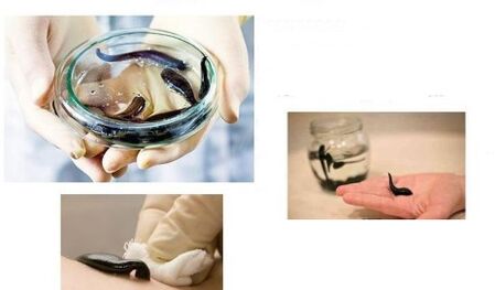 hirudoterapia për artrozën